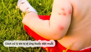 Cách xử lý khi bị dị ứng thuốc diệt muỗi